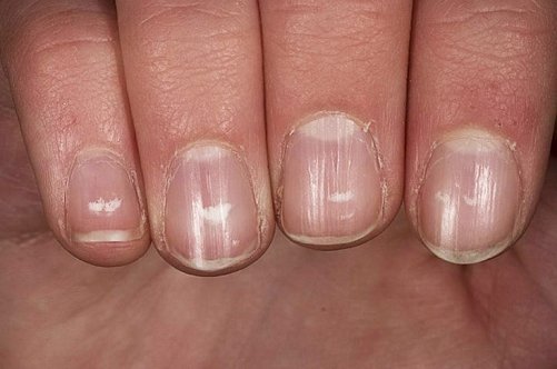 vannak állatok gombás köröm foot nail gomba homeopátiás kezelés