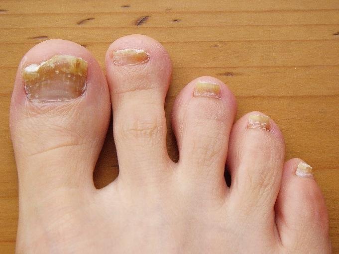 Foot gombák: tünetek. Hogyan lehet megszabadulni a lábakról Fungus: Kövesse a higiéniai lábakat