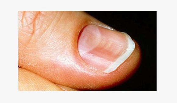 nail gomba lábakon kezelés és kezek