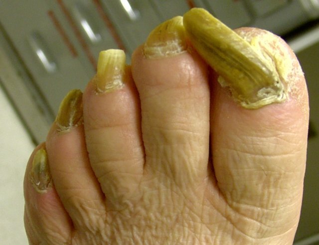 Gombás fertőzés a lábujjak között