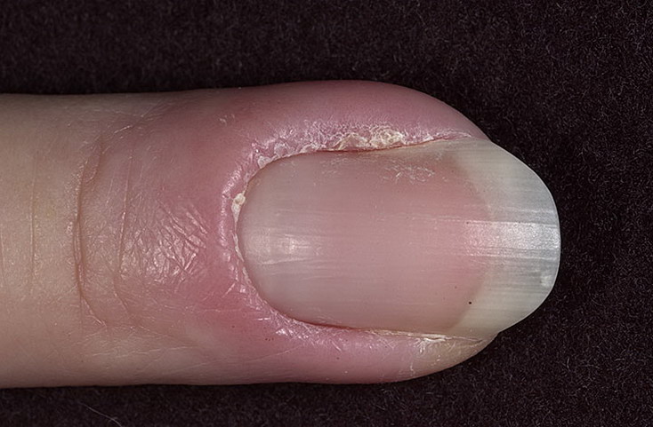 nail gombusz kezelés a kezében