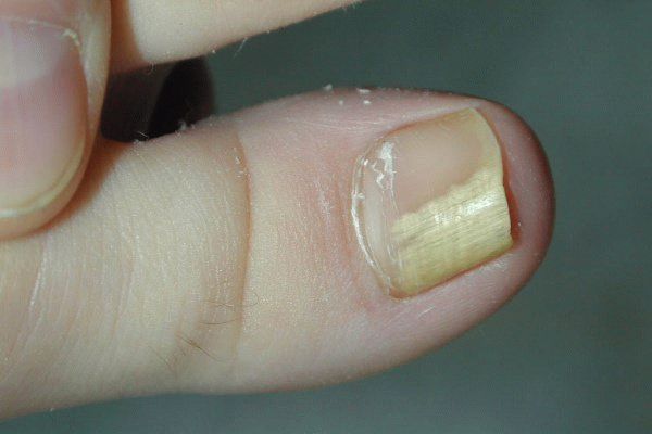 nail fungus diagnosztika és kezelés