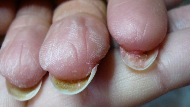meséld el, hogyan gyógyítottad meg a körömgombát nail gombák kód az icd